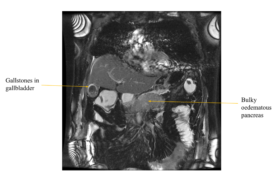 Acute Pancreatitis 13 Pancreatitis MRCP