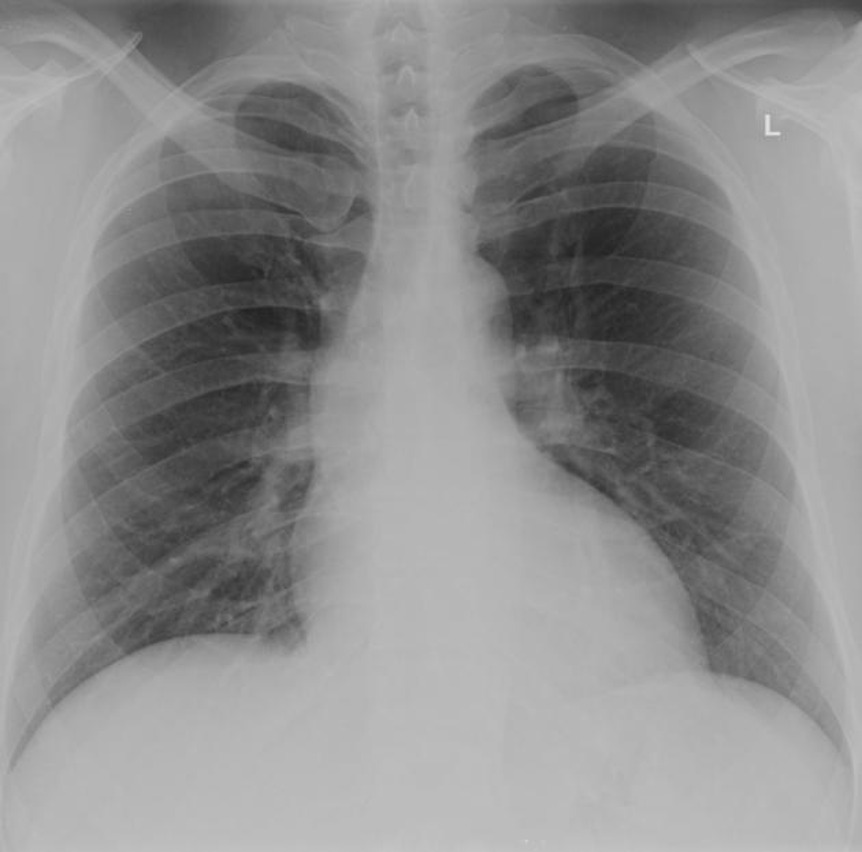 Breathlessness Station 1 normal CXR in PE