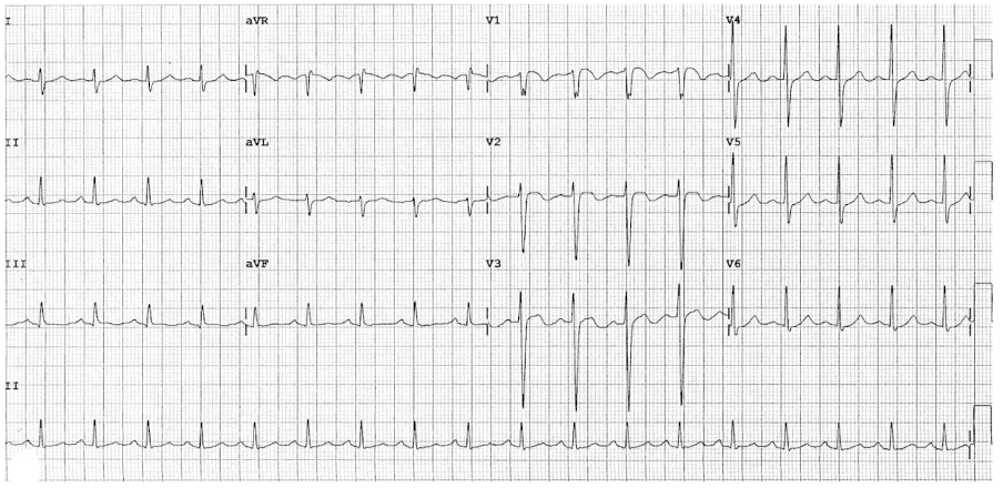 Breathlessness Station 3 sinus tachy ECG PE