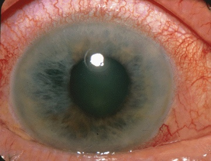 Painful red eye station mla medics
