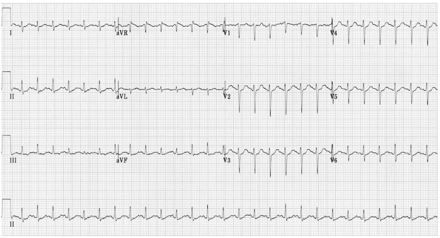 Breathlessness Station (A-E) 3 ECG sinus tachy