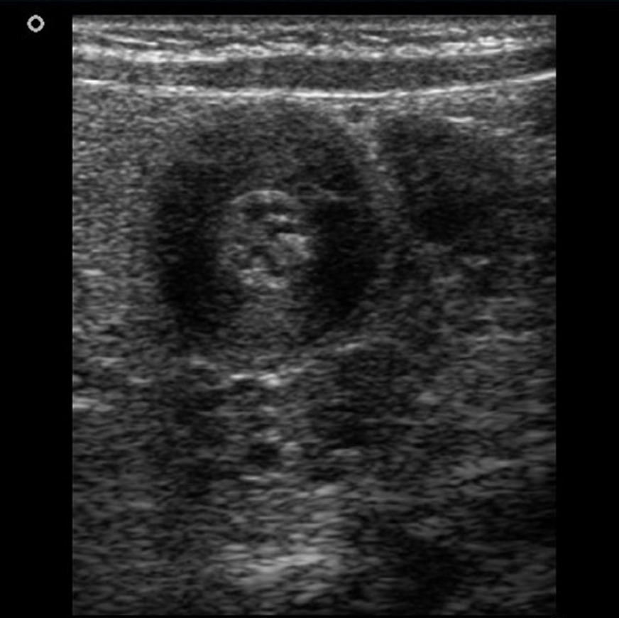 pyloric stenosis US 2