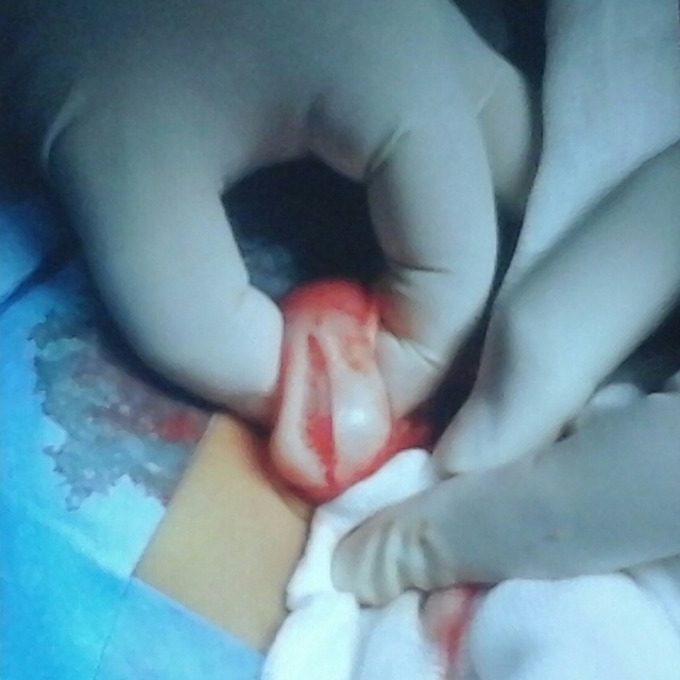 pyloric stenosis surgery